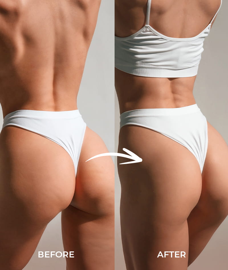 ANTI-CELLULITE THERAPY + GIFT - indossachisei.it